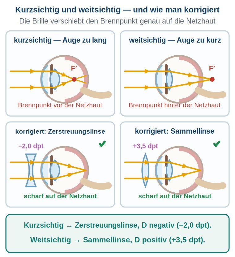 Grafik: vier Augenquerschnitte – kurzsichtig und weitsichtig ohne Korrektur, darunter jeweils mit Zerstreuungs- beziehungsweise Sammellinse korrigiert, Brennpunkt genau auf der Netzhaut.